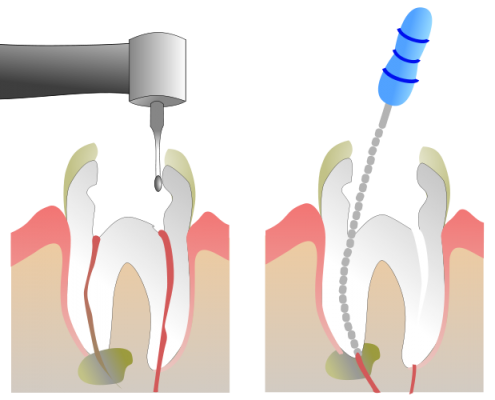 Endodoncias Madrid